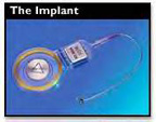 implant.jpg (12575 bytes)